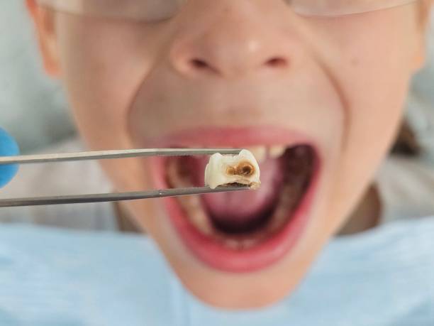 Best Chipped Tooth Repair Near Me  in West Hollywood, CA